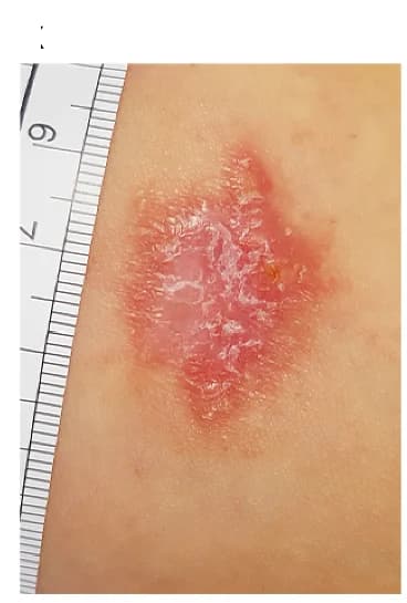 Open access visualization of Photo, Lesion, Punch Biopsy, Cryotherapy, Images