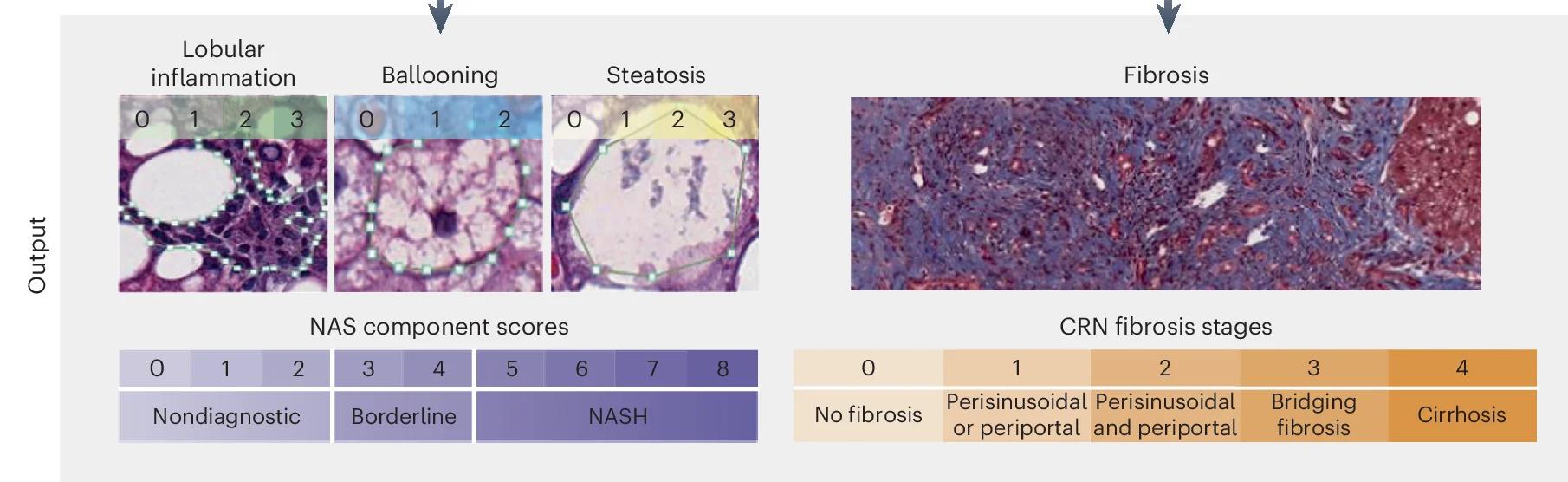 Open access visualization of Microscopy, Machine Learning, MASH CRN, Fibrosis