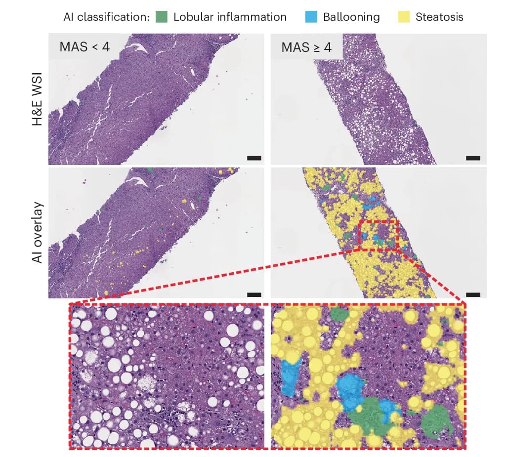 Open access visualization of Microscopy, Photo, H&E Stained Slides, AI Overlays, Steatosis