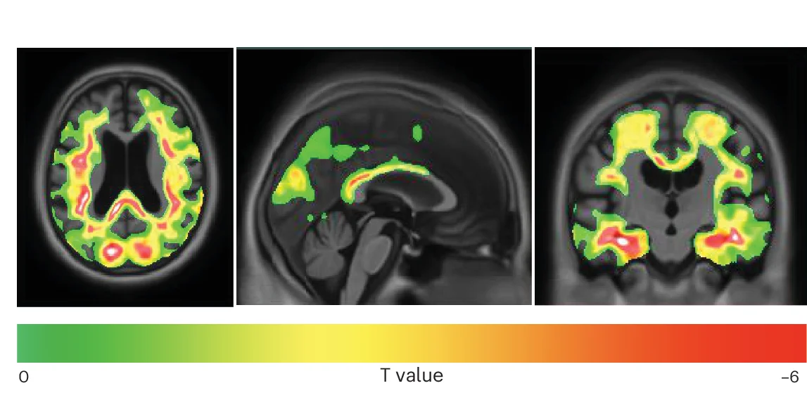 Open access visualization of Microscopy, Voxel-wise Association Analyses, STA, t-Tau Ratio, Tau-PET