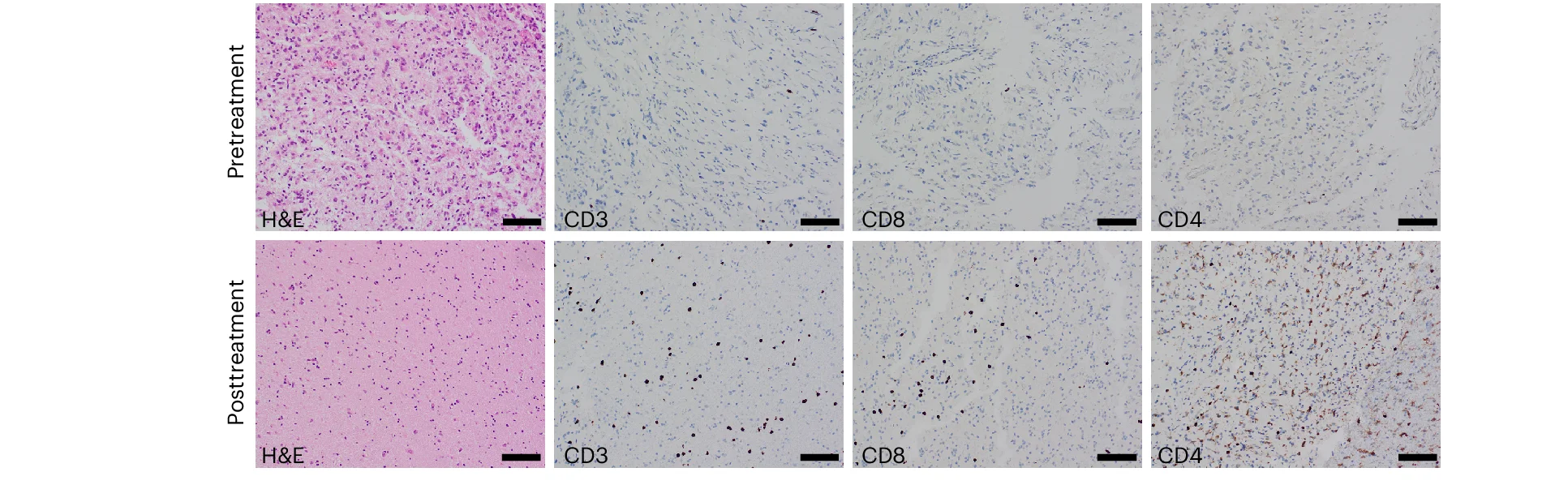 Open access visualization of Microscopy, Hematoxylin and Eosin, IHC, Pretreatment GBM Specimens, Posttreatment GBM Specimens