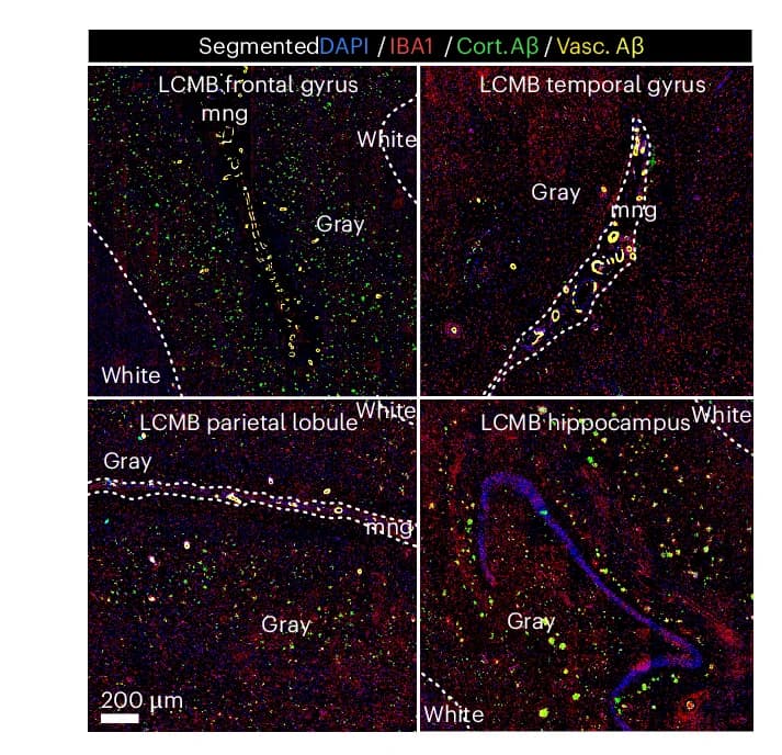 Open access visualization of Microscopy, Confocal Images, Segmented Abeta Burden, Microgliosis, Lecanemab Treated Patient Brain