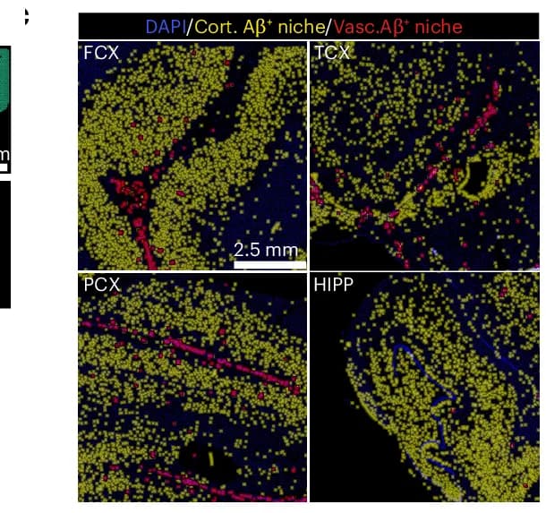 Open access visualization of Microscopy, Cortical Amyloid beta, Vascular Amyloid beta, Brain Regions, Lecanemab