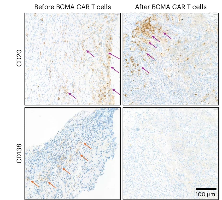 Open access visualization of Microscopy, CD20+ B Cells, CD138+ Plasma Cells, Lymph Node Biopsy, BCMA CAR T Cell Therapy