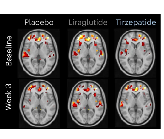 Open access visualization of Heatmap, Brain Activation, Baseline, Week 3