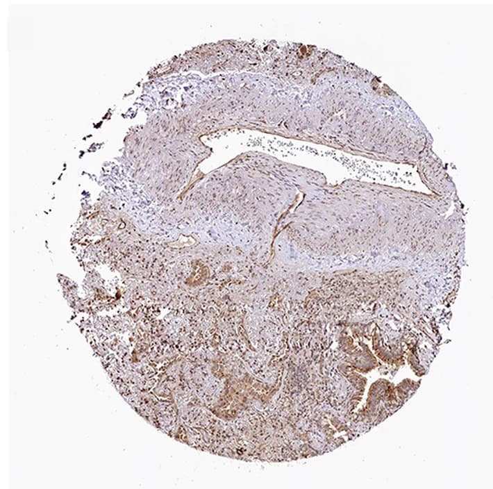 Open access visualization of Microscopy, Immunohistochemistry, HOXC8, LUAD