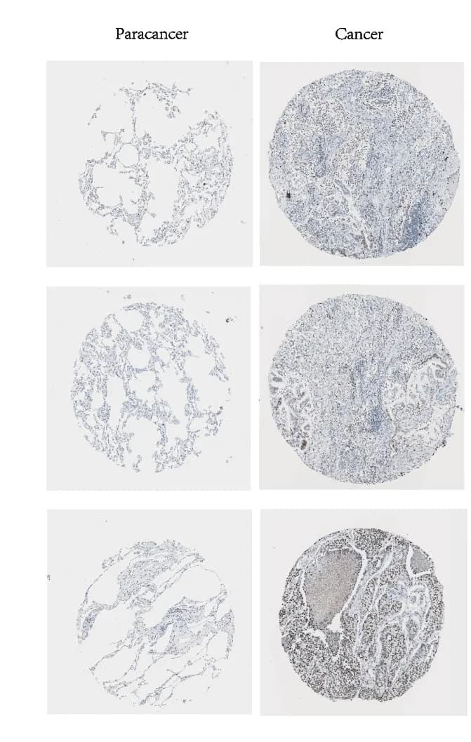 Open access visualization of Microscopy, Photo, EZH2 Immunohistochemistry, LUAD Cancer, Normal Tissues
