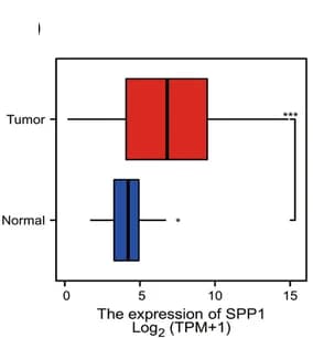 Open access visualization of Box Plot, SPP1, Gene Expression, HCC, TCGA Data