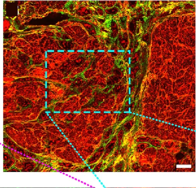 Open access visualization of Microscopy, Composite Image, Collagen Fibers, Adenocarcinoma, Muscularis