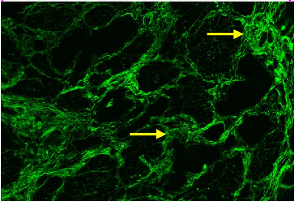 Open access visualization of Microscopy, Zoomed Image, Collagen Fibers, Adenocarcinoma, Muscularis