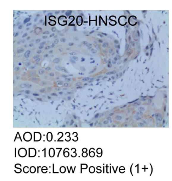 Open access visualization of Microscopy, Immunohistochemistry, ISG20, HNSCC, Tumor Tissue
