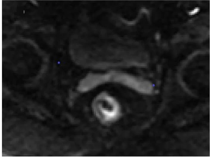 Open access visualization of Microscopy, DWI, mrEMVI, Lymphovascular Invasion, DWI Model