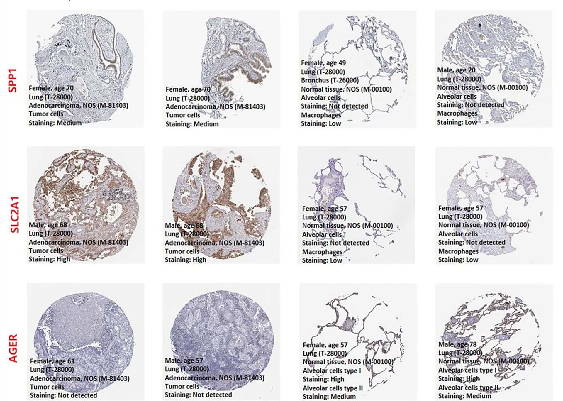 Open access visualization of Microscopy, Immunohistochemistry, LUAD Tissues, Normal Lung Tissues