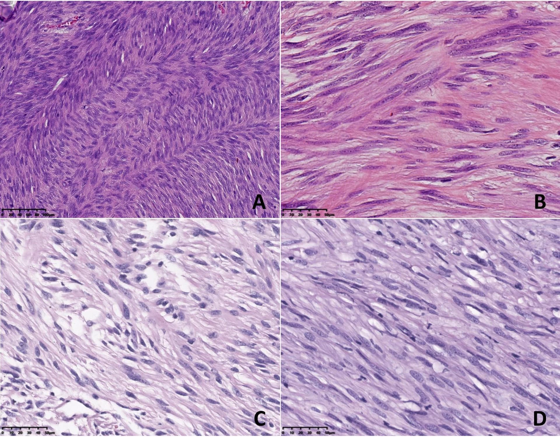 Open access visualization of Microscopy, Spindle Cells, Tumor Cells, Cell Morphology, Hypercellular Pattern