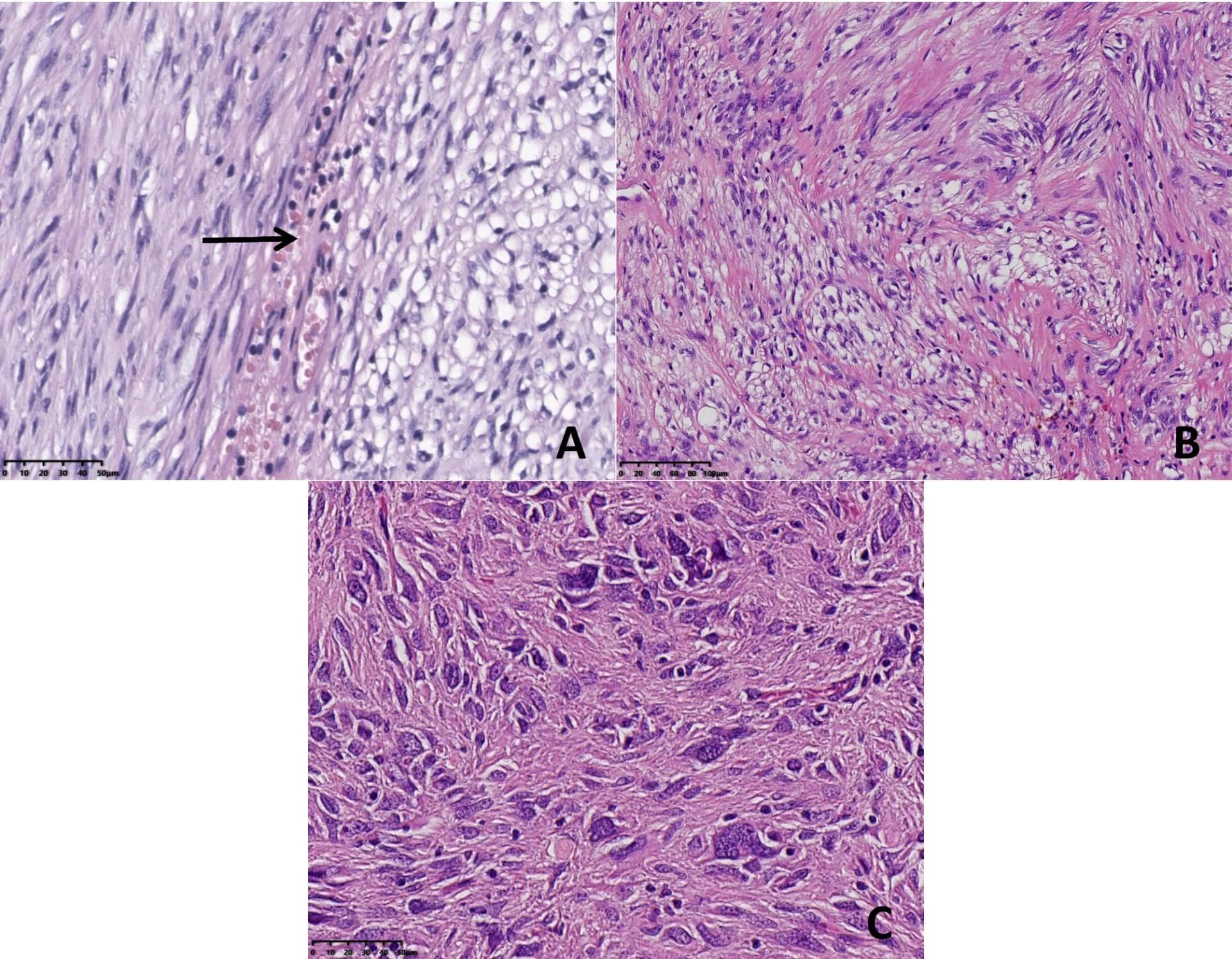 Open access visualization of Microscopy, Spindle Cells, Epithelioid Cells, Tumor Cells