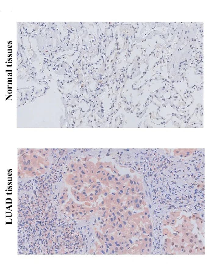Open access visualization of Microscopy, IHC, Clinical Tissues, Lung Adenocarcinoma