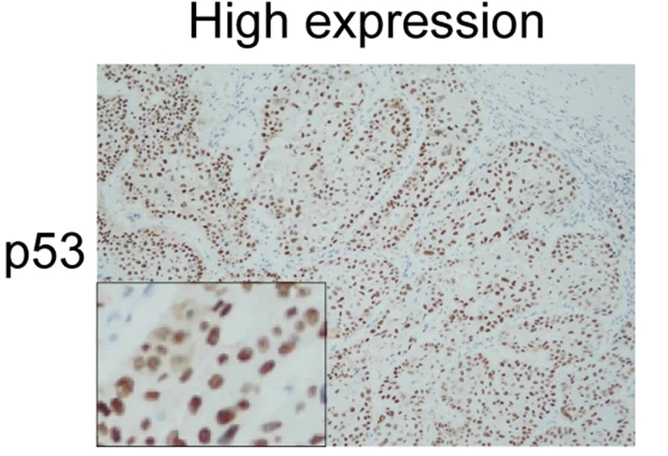Open access visualization of Microscopy, Photo, Tumor Cells, Nuclear Staining
