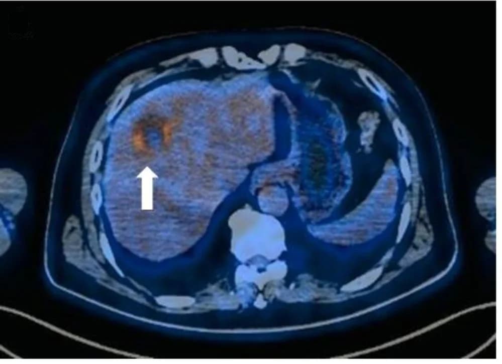 Open access visualization of Microscopy, Photo, Liver Metastasis, PD-L1 Staining, 18 F-FDG Uptake