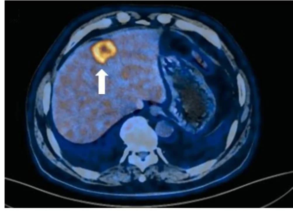 Open access visualization of Photo, Liver Metastasis, PD-L1 Staining, 18 F-FDG PET/CT, Immunohistochemistry