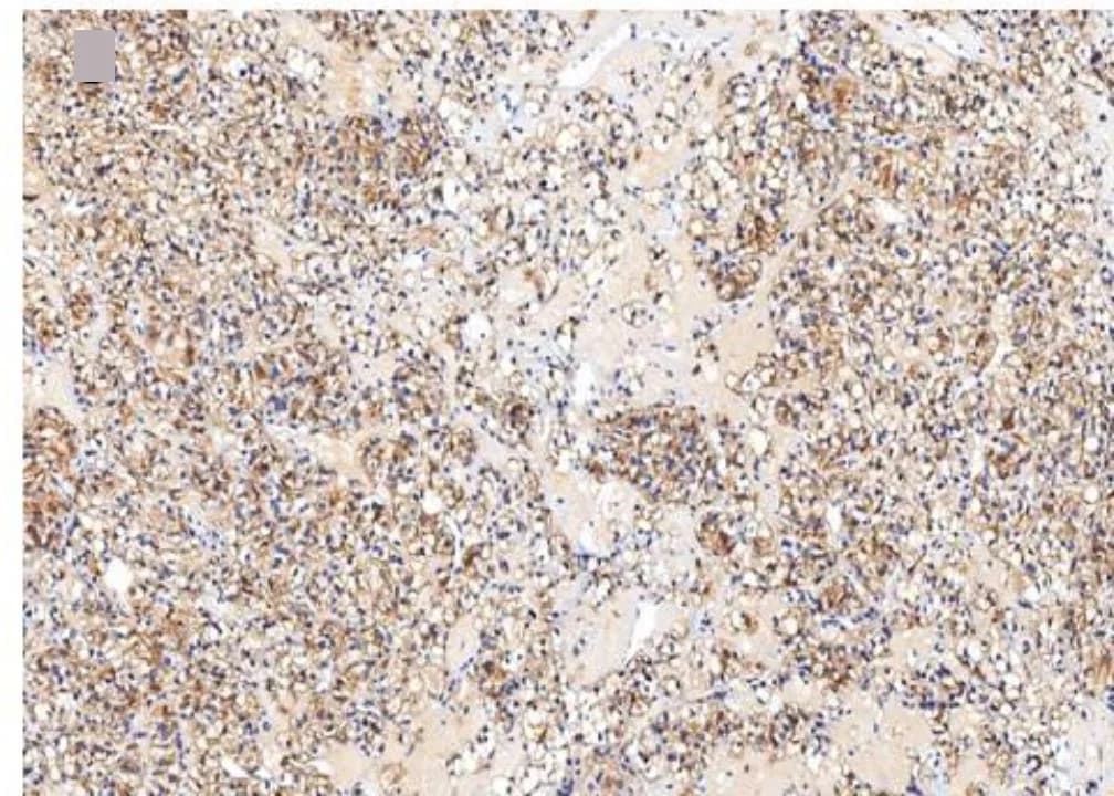 Open access visualization of Microscopy, Photo, Liver Metastasis, PD-L1 Staining, 18 F-FDG PET/CT