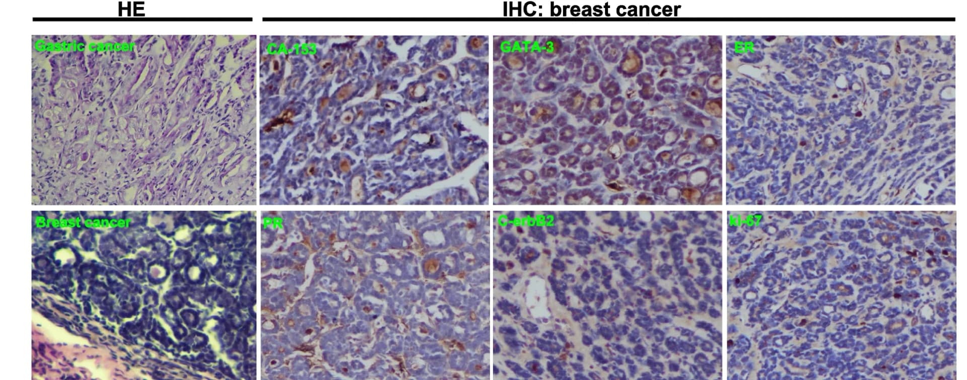 Open access visualization of Microscopy, Photo, Gastric Cancer, Breast Tumor, Lobular Carcinoma