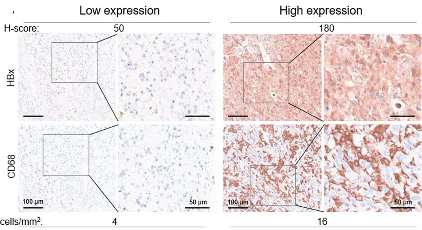 Open access visualization of Microscopy, H&E staining, Immunohistochemical staining, HBx, CD68
