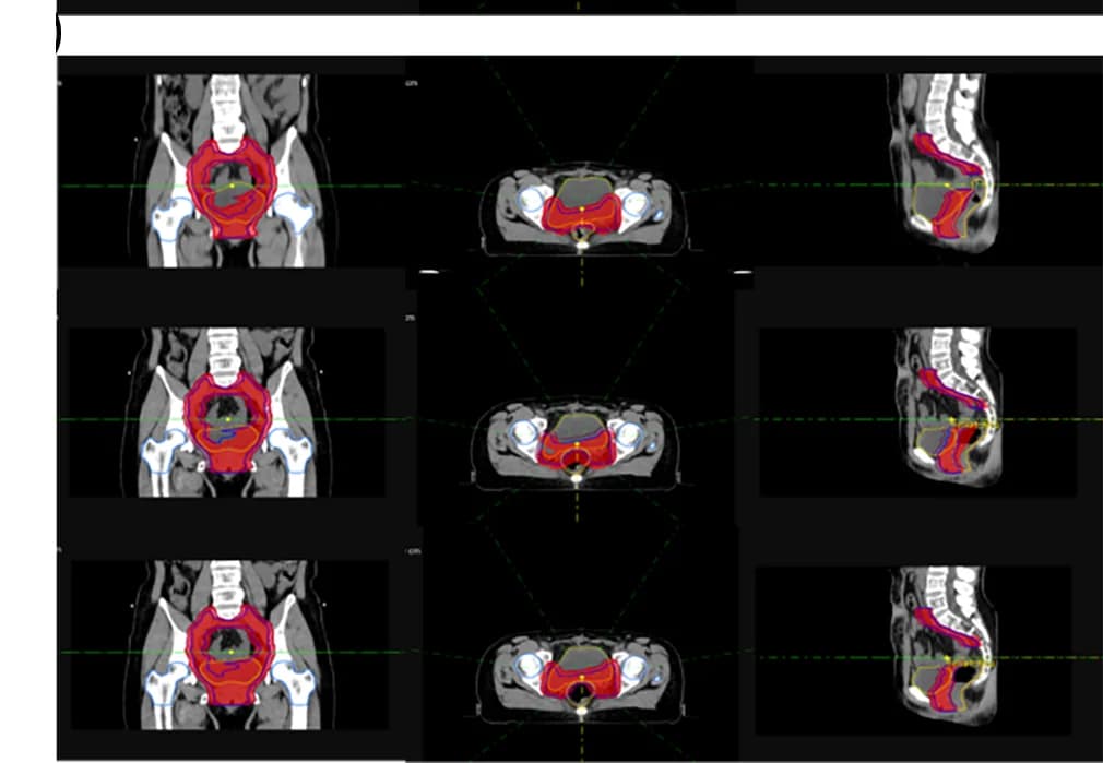 Open access visualization of Photo, Dose distribution, Plan0, VPlan, APlan