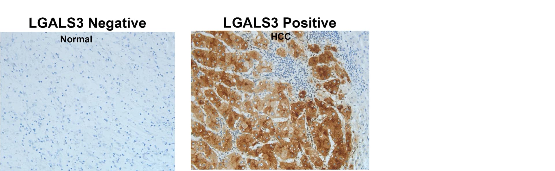 Open access visualization of Microscopy, LGALS3, Tumor tissue, HCC, Progression