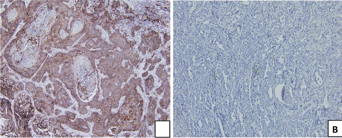 Open access visualization of Microscopy, Immunohistochemical staining, PD-L1 expression, CPS score