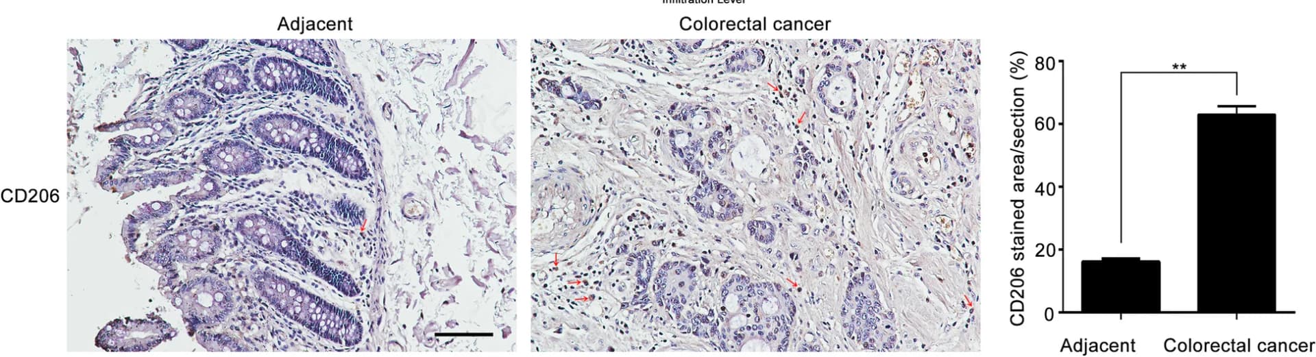 Open access visualization of Bar Plot, Microscopy, Immunohistochemistry, CD206, CRC Tissues