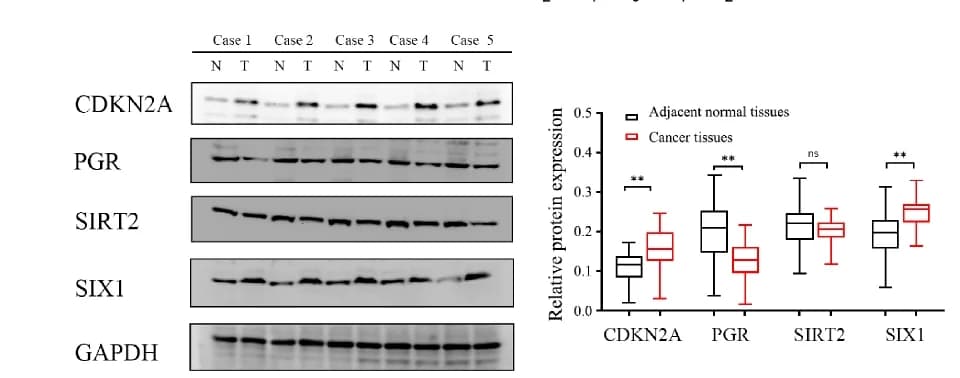 Open access visualization of Box Plot, Gel, EMT-related genes, EC tissues, Tumor tissue