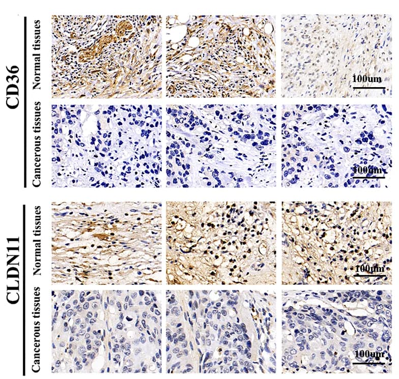 Open access visualization of Microscopy, Immunohistochemical Analysis, Prognostic Genes, Osteosarcoma Cancerous Tissues, Normal Tissues
