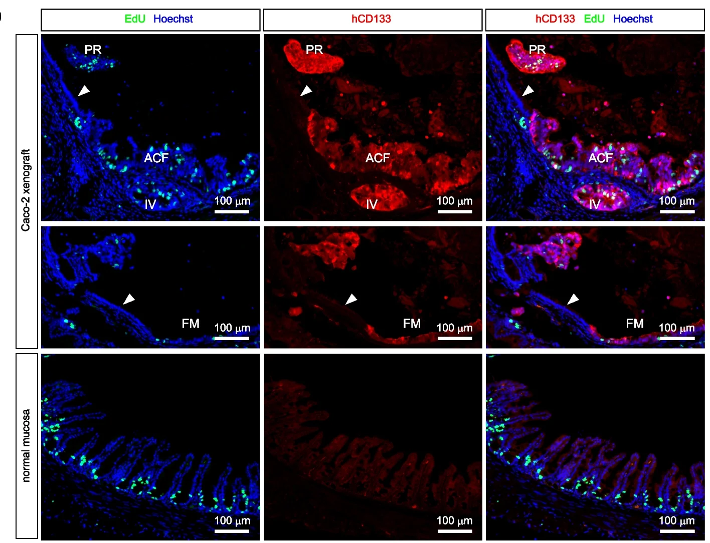 Open access visualization of Microscopy, Cell Proliferation, Caco-2 Cell Tumors, EdU Staining, mScarlet