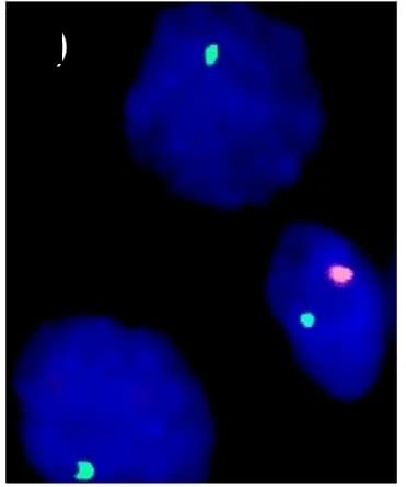 Open access visualization of Microscopy, Chromosome Y, Tumor Cell, Normal Cell, Chromosome X