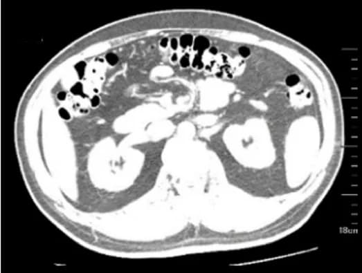 Open access visualization of Photo, CT Images, Renal Vein