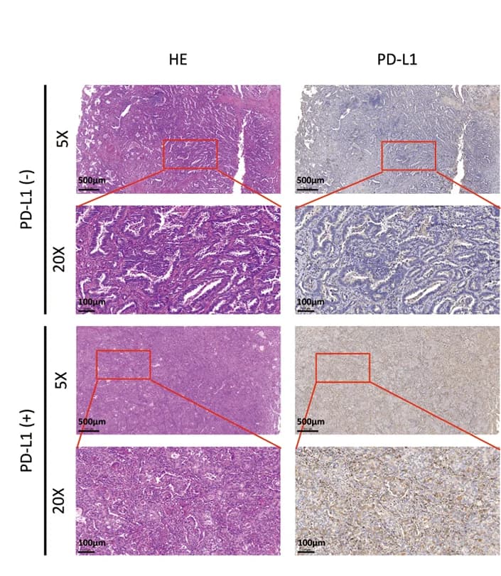 Open access visualization of Microscopy, HE Staining, PD-L1 Immunohistochemical Staining, Tumor Samples, LUAD Patients