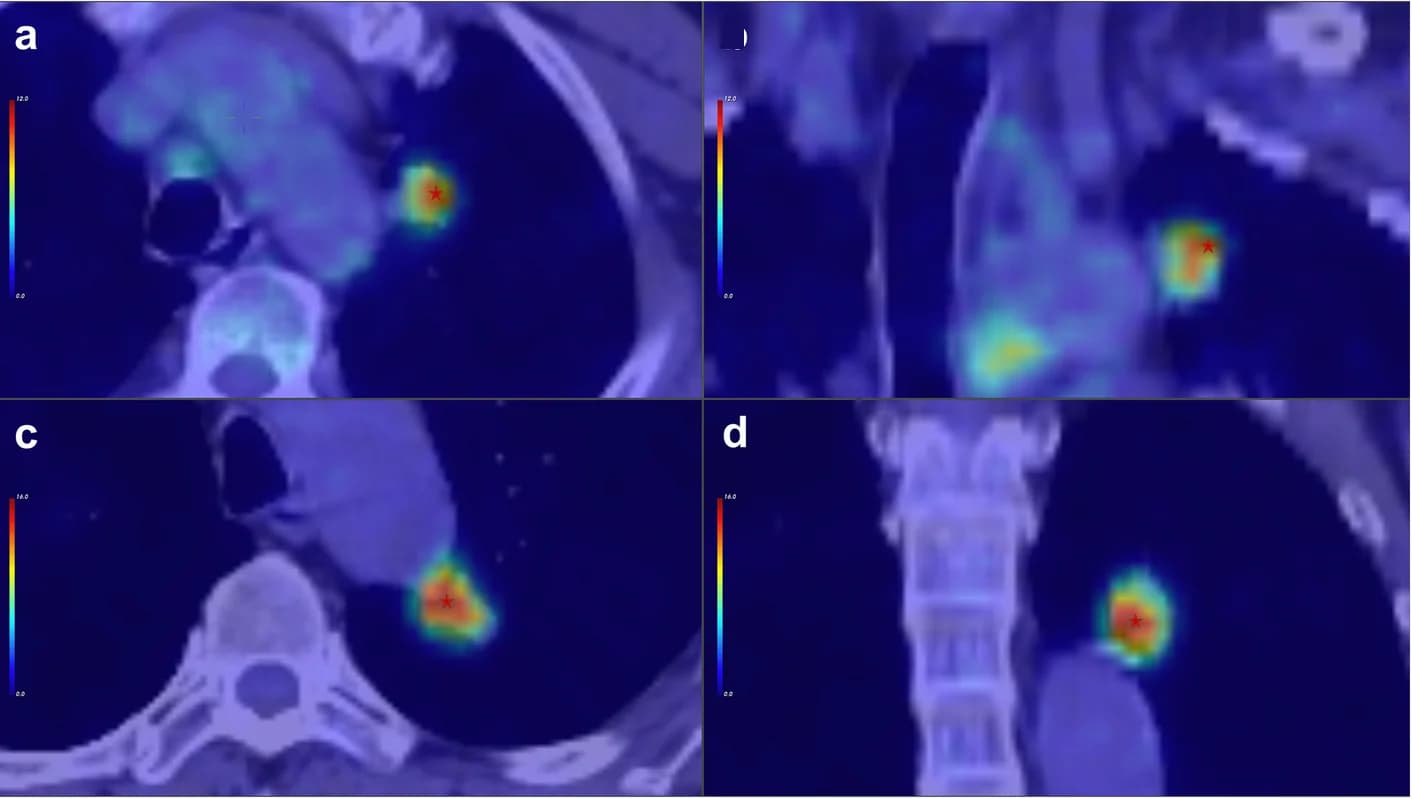 Open access visualization of Heatmap, Photo, Coronal FDG PET/CT Images, Lung Adenocarcinoma, Recurrence