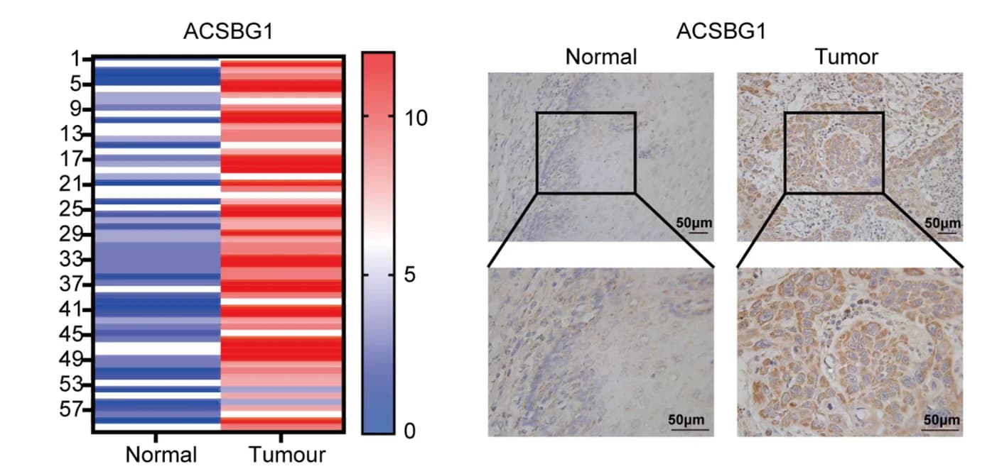 Open access visualization of Heatmap, Microscopy, ACSBG1, ESCC Tissues, ESCC Cells