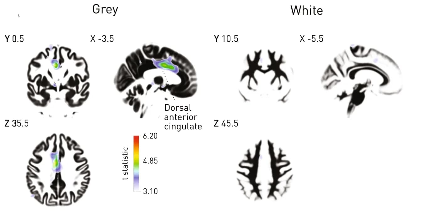 Open access visualization of Microscopy, Grey Matter, White Matter, Voxel-Based Morphometry, Mortality