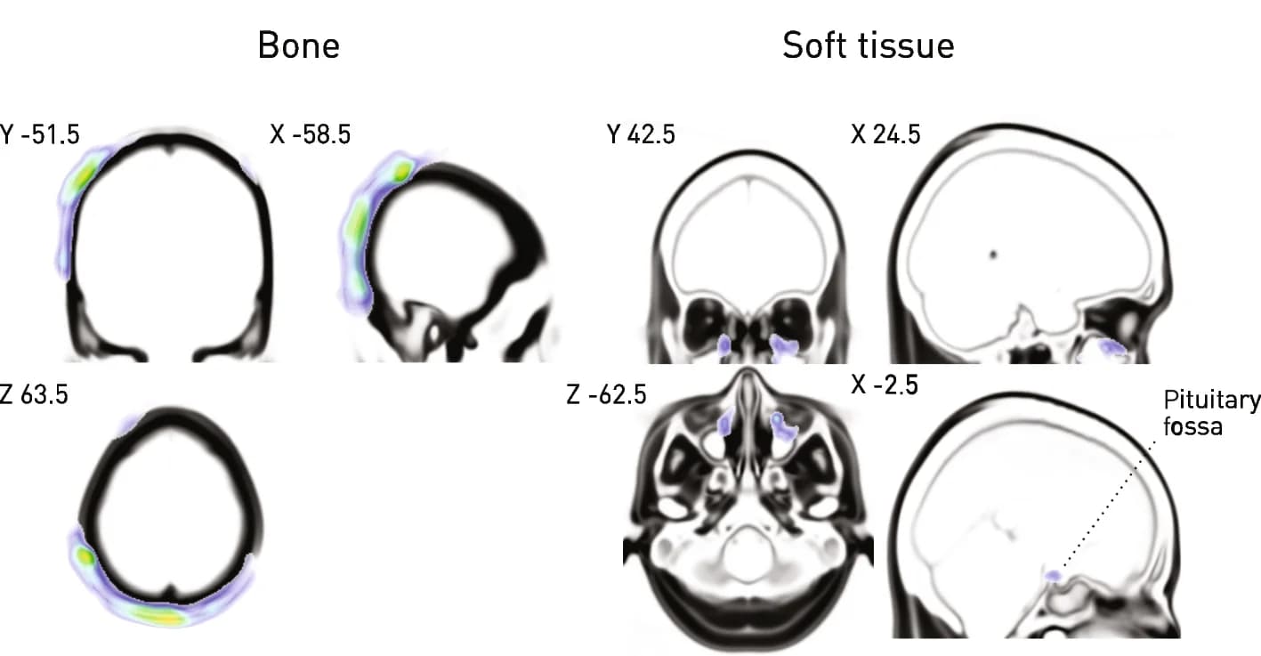 Open access visualization of Microscopy, Bone, Soft Tissue, Voxel-Based Morphometry, Mortality
