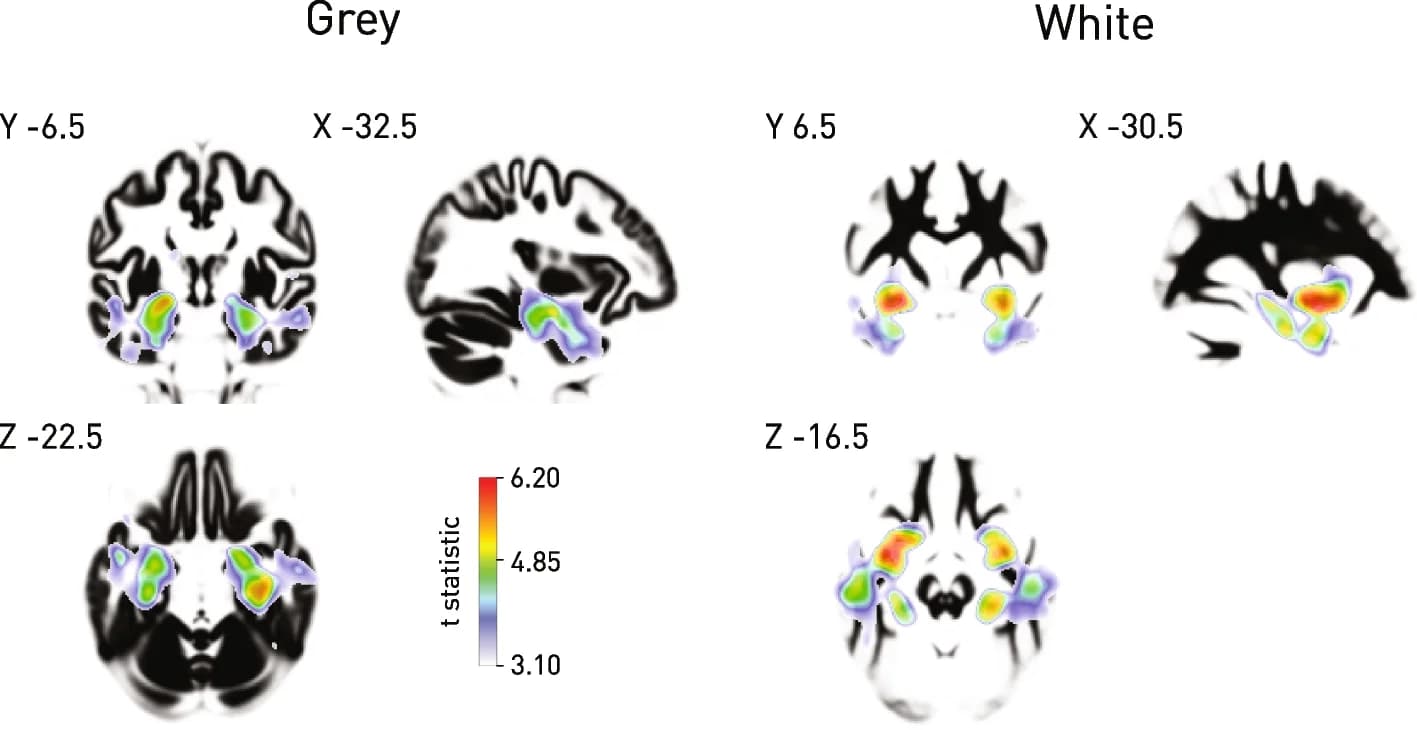 Open access visualization of Heatmap, Grey Matter, White Matter, Dementia, Voxel-Based Morphometry