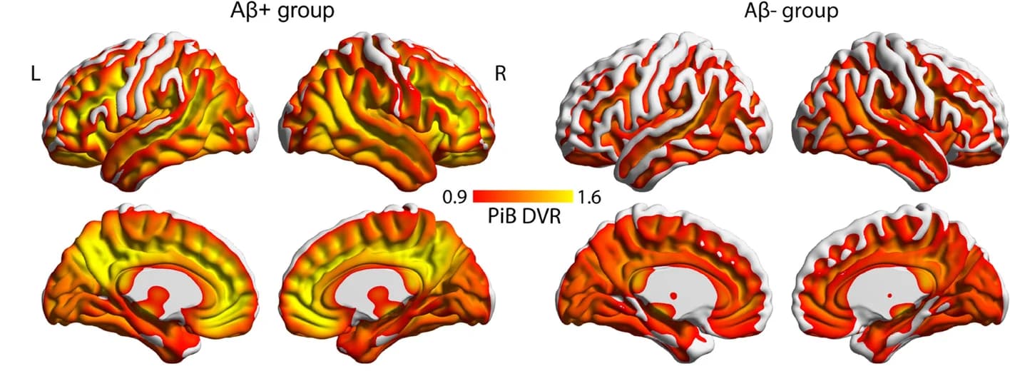 Open access visualization of 3D Plot, PET, Aβ Distribution, Aβ+ Group, Aβ- Group