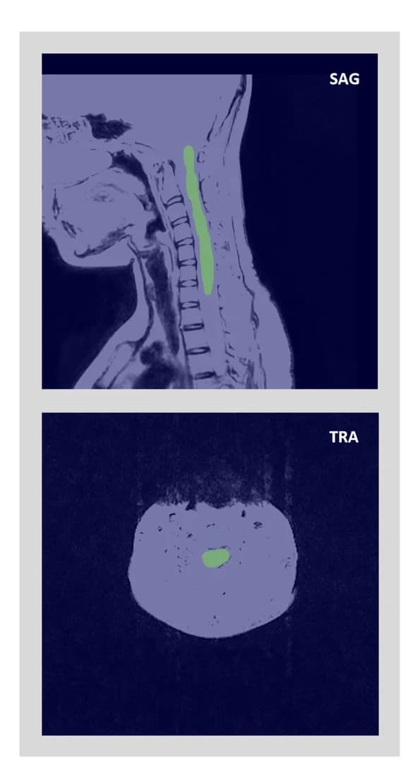 Open access visualization of Microscopy, Photo, Lesion Segmentation, Automatic Segmentation Model, SAG