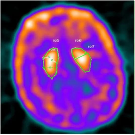 Open access visualization of Microscopy, Basal Ganglia, Healthy Control, Caudate, Putamen