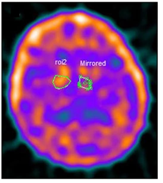 Open access visualization of Microscopy, Basal Ganglia, Parkinson's Disease, Putamen, ROI