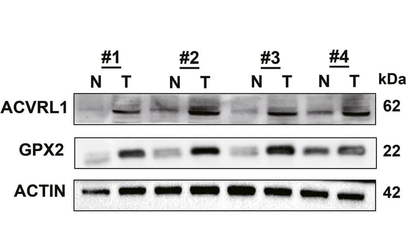 Open access visualization of Gel, Protein Level, ACVRL1, GPX2, CRC Tissues