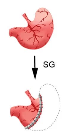 Open access visualization of Illustration, Workflow, Sleeve Gastrectomy, Surgical Diagram