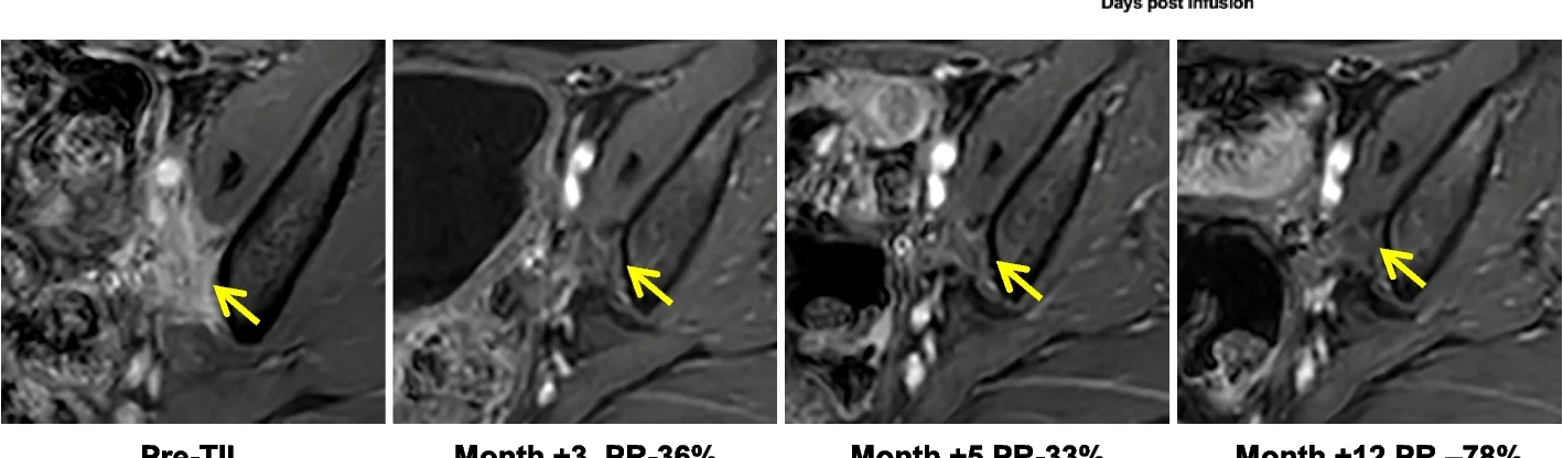 Open access visualization of Microscopy, MRI Images, Target Lesions, Cervical Cancer, TILs