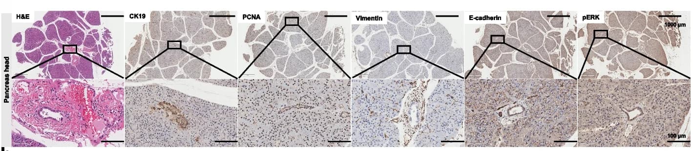 Open access visualization of Microscopy, H&E Staining, IHC Staining, Pancreatic Head, Tumor