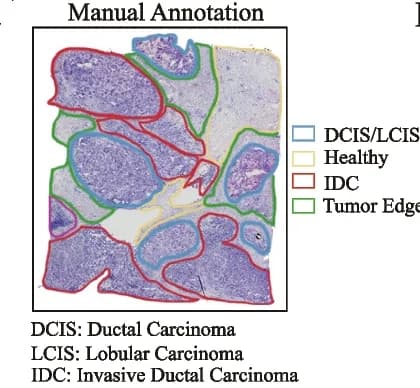 Open access visualization of Microscopy, Visium Spatial Transcriptomics, Breast Cancer, Pathologist Annotation, IDC